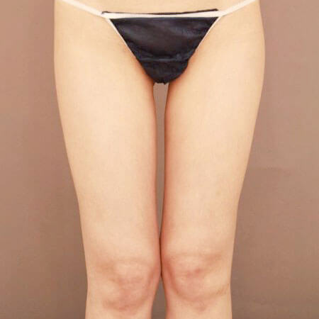 太もも全周＋お尻＋膝の脂肪吸引【術前／3ヶ月 30歳女性】の術後写真