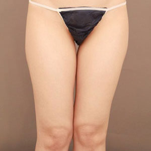 太もも全周＋お尻＋膝の脂肪吸引【術前／3ヶ月 30歳女性】の術前写真