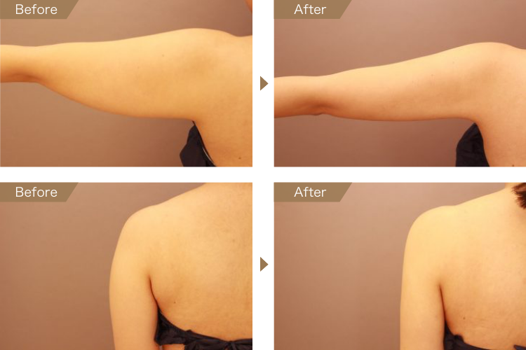 二の腕・肩 ベイザー脂肪吸引 症例画像（23歳女性）
