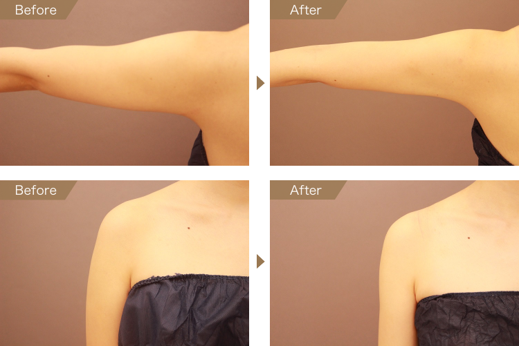 二の腕・肩 ベイザー脂肪吸引 症例画像（30歳女性）
