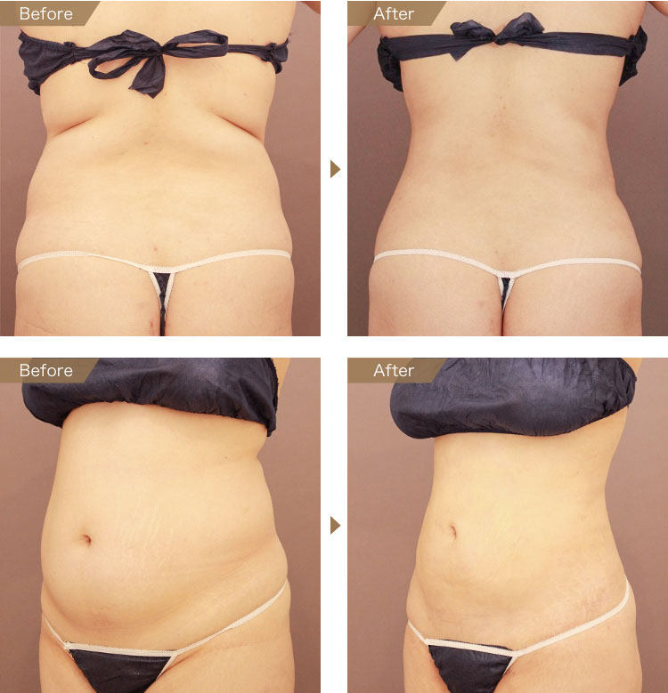 お腹・腰 ベイザー脂肪吸引 症例画像（23歳女性）