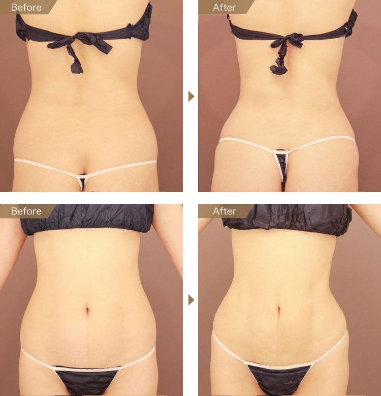 お腹・腰 ベイザー脂肪吸引 症例画像（30歳女性）