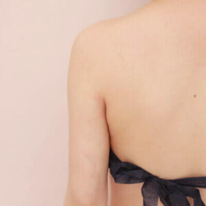 二の腕・肩の脂肪吸引【術前／1ヶ月 24歳女性】の術後写真