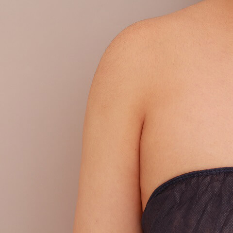 二の腕・肩の脂肪吸引【術前／6ヶ月 24歳女性】の術後写真