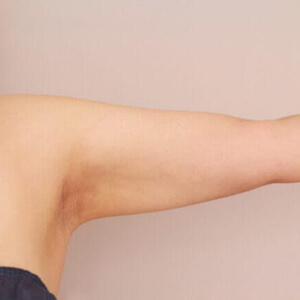 二の腕・肩の脂肪吸引【術前／3ヶ月 39歳女性】の術後写真