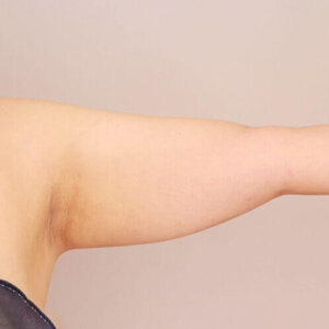 二の腕・肩の脂肪吸引【術前／3ヶ月 39歳女性】の術前写真