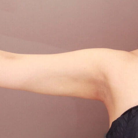 二の腕・肩の脂肪吸引【術前／3ヶ月 25歳女性】の術後写真