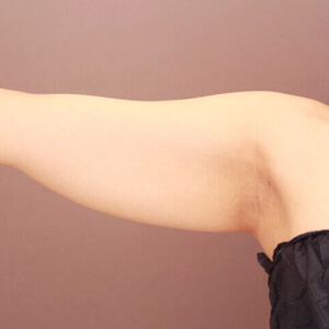 二の腕・肩の脂肪吸引【術前／3ヶ月 25歳女性】の術前写真