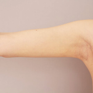 太ももの脂肪吸引【術前／6ヶ月 20歳女性】の術後写真