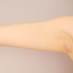 太ももの脂肪吸引【術前／6ヶ月 20歳女性】の術前写真