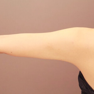 二の腕・肩の脂肪吸引【術前／6ヶ月 23歳女性】の術後写真