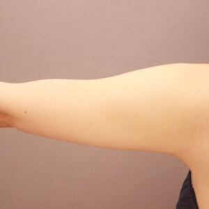 二の腕・肩の脂肪吸引【術前／6ヶ月 23歳女性】の術前写真