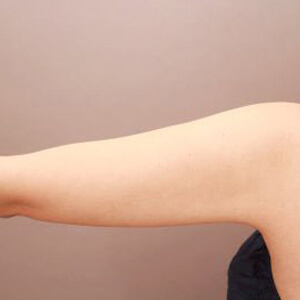 二の腕・肩の脂肪吸引【術前／6ヶ月 30歳女性】の術後写真