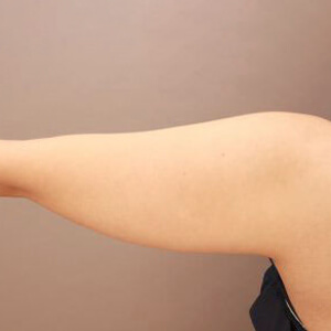 二の腕・肩の脂肪吸引【術前／6ヶ月 30歳女性】の術前写真