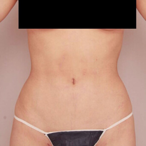 お腹・腰の脂肪吸引【術前／6ヶ月 21歳女性】の術後写真