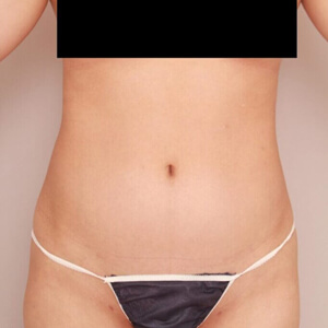 お腹・腰の脂肪吸引【術前／6ヶ月 21歳女性】の術前写真