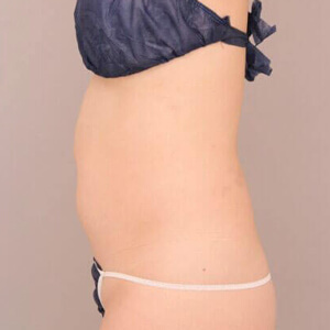 お腹・腰の脂肪吸引【術前／6ヶ月 29歳女性】の術前写真