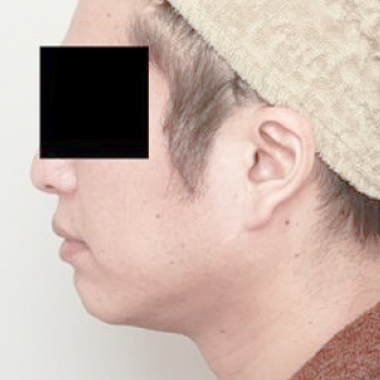 顔(頬+顎下)の脂肪吸引【術前/3ヶ月後 44歳男性】の術後写真