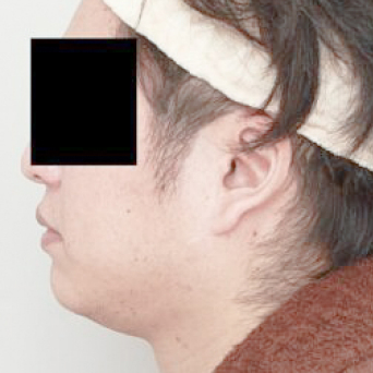 顔(頬+顎下)の脂肪吸引【術前/3ヶ月後 44歳男性】の術前写真