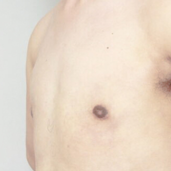 胸の脂肪吸引(偽性女性化乳房)【術前/1ヶ月後 35歳男性】の術後写真