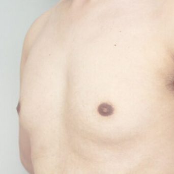 胸の脂肪吸引(偽性女性化乳房)【術前/1ヶ月後 35歳男性】の術前写真