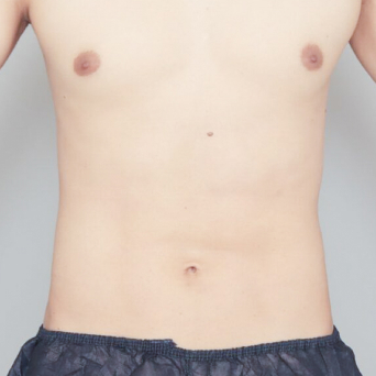 お腹・腰の脂肪吸引【術前/6ヶ月後 29歳男性】の術後写真