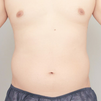 お腹・腰の脂肪吸引【術前/6ヶ月後 29歳男性】の術前写真
