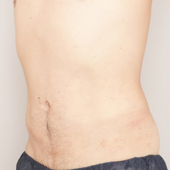 お腹・腰の脂肪吸引【術前/3ヶ月後 40代男性】の術後写真