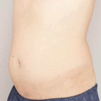 お腹・腰の脂肪吸引【術前/3ヶ月後 40代男性】の術前写真