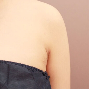 二の腕+肩+脇肉【術前/術後1ヶ月 20代女性】の術後写真