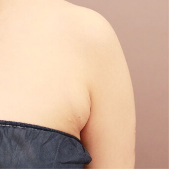 二の腕+肩+脇肉【術前/術後1ヶ月 20代女性】の術前写真