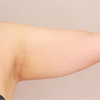 二の腕+肩【術前/術後3ヶ月 30代女性】の術前写真