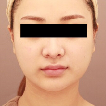 頬+顎下【術前/術後6ヶ月 20代女性】