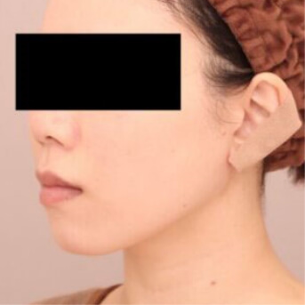 頬+顎下【術前/術後6ヶ月 20代女性】の術後写真
