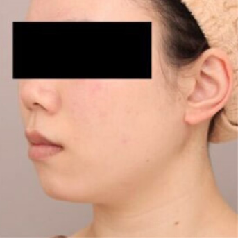 頬+顎下【術前/術後6ヶ月 20代女性】の術前写真