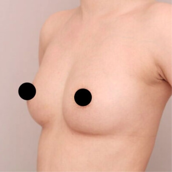 コンデンスリッチ豊胸【術後3ヶ月 30代女性】