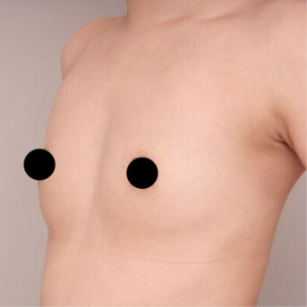 コンデンスリッチ豊胸【術前/30代女性】