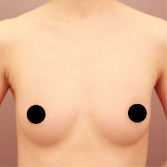 コンデンスリッチ豊胸【術前/術後1ヶ月 40代女性】の術後写真