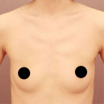 コンデンスリッチ豊胸【術前/術後1ヶ月 40代女性】の術前写真