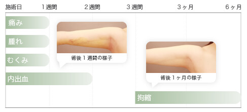 術後のダウンタイム