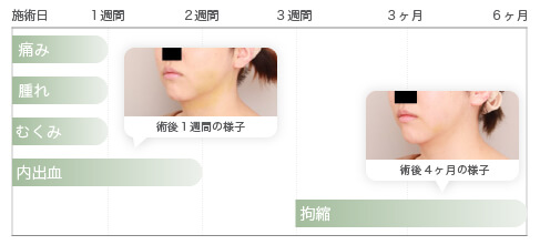 術後のダウンタイム