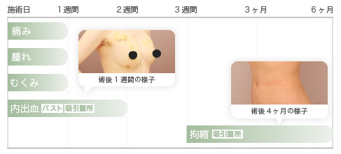 術後のダウンタイム