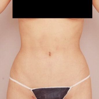 腹部全体＋胸下＋腰の脂肪吸引【術前／6ヶ月後 21歳女性】の術後写真