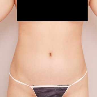 腹部全体＋胸下＋腰の脂肪吸引【術前／6ヶ月後 21歳女性】の術前写真