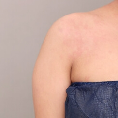 二の腕+肩の脂肪吸引【35歳女性】の術前写真
