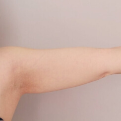 二の腕+肩の脂肪吸引【51歳女性】の術前写真