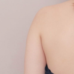 二の腕+肩の脂肪吸引【27歳女性】の術前写真