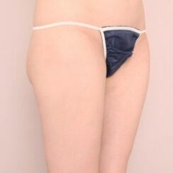太もも全周+お尻+膝の脂肪吸引【21歳女性】術後写真