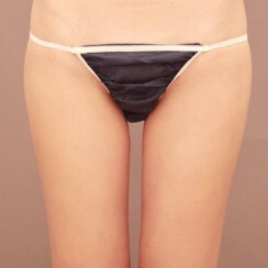 太もも全周+お尻の脂肪吸引【20歳女性】の術後写真