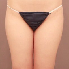 太もも全周+お尻の脂肪吸引【20歳女性】の術前写真